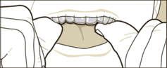 inserting clear retainers