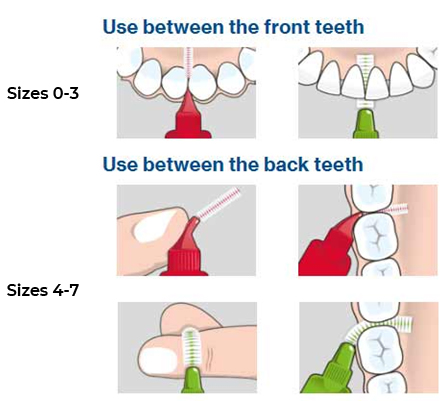 Inter-dental Brushing Technique
