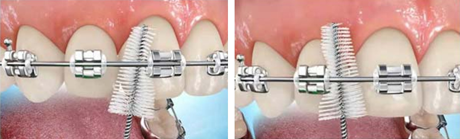 Interdental Brushing with Braces 