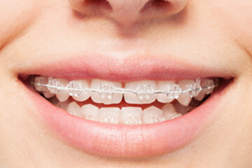 Clear Fixed Braces