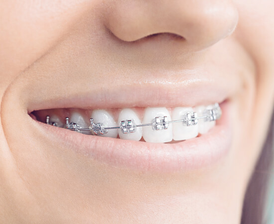 Fitting Your Fixed Brace